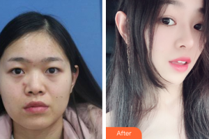 深圳貝加美醫(yī)學美容門診部夏成龍整形價格表附假體隆鼻案例展示