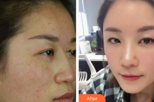 深圳貝加美醫(yī)學美容門診部鄒媛整形價格表附自體脂肪填充案例展示