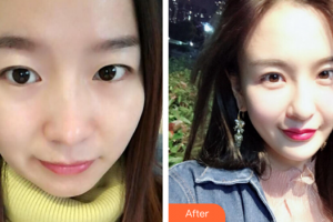 深圳福雅醫(yī)學美容門診部肖劍光整形價格表附自體脂肪填充案例展示