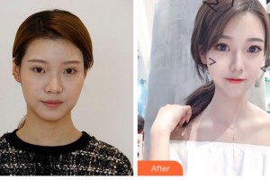 眉山華信醫(yī)學(xué)整形美容醫(yī)院李東泰整形價(jià)格表附切開雙眼皮案例展示