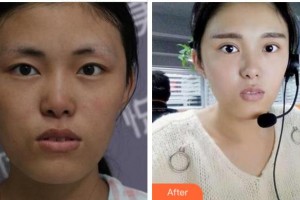 眉山市人民醫(yī)院醫(yī)學(xué)美容科陳輝整形價(jià)格表附切開雙眼皮案例展示