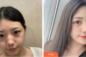 眉山天使醫(yī)療美容整形醫(yī)院鄭靜整形價(jià)格表附激光祛斑案例展示