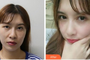 眉山眼耳鼻咽喉專科醫(yī)院龔恩進(jìn)整形價(jià)格表附切開雙眼皮案例展示