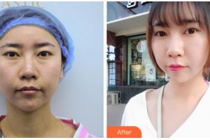 眉山市中醫(yī)院眼科葉小琴整形價(jià)格表附祛眼袋案例展示