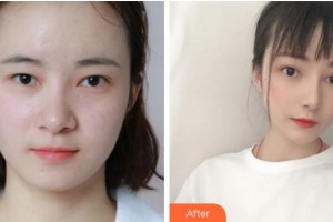 眉山市康復(fù)醫(yī)院眼科陳黎霞整形價(jià)格表附眼部綜合案例展示