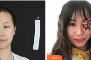 眉山市康復(fù)醫(yī)院眼科李健住院醫(yī)師整形價(jià)格表附眼部綜合案例展示