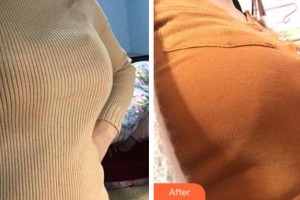 宜賓瑪莉亞醫(yī)院整形美容中心李洪山整形價(jià)格表附自體脂肪隆胸案例展示