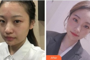 宜賓市第一人民醫(yī)院整形燒傷科呂英整形價(jià)格表附激光祛斑案例展示