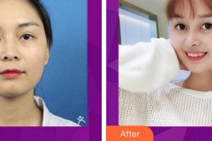 宜賓市第一人民醫(yī)院整形燒傷科陳國(guó)雙整形價(jià)格表附鼻部綜合案例展示