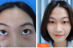 宜賓愛爾優(yōu)視眼科醫(yī)院宋玉偉整形價(jià)格表附激光去眼袋案例展示