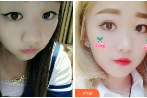 宜賓愛爾優(yōu)視眼科醫(yī)院整形價(jià)格表附眼部修復(fù)案例展示