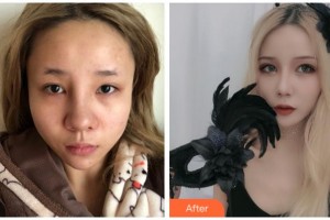 宜賓曼薇醫(yī)學(xué)整形醫(yī)院陳誠(chéng)整形價(jià)格表附眼部綜合案例展示