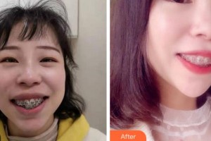 宜賓口腔醫(yī)院何明第整形價(jià)格表附金屬托槽矯正案例展示