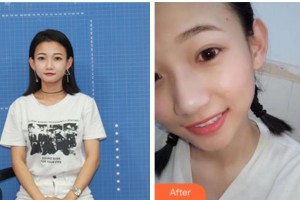 宜賓口腔醫(yī)院佘曉晴整形價(jià)格表附牙齒隱形矯正案例展示