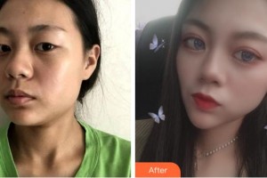 宜賓天使之翼醫(yī)療美容整形門診部周洪超整形價(jià)格表附眼部綜合案例展示