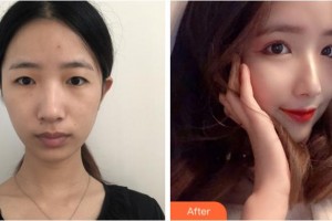 宜賓天使之翼醫(yī)療美容整形門診部尤軍整形價(jià)格表附眼部綜合案例展示