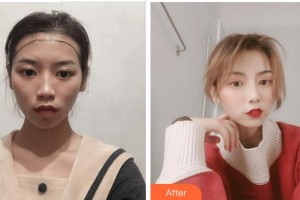 宜賓天使之翼醫(yī)療美容整形門診部王光斌整形價(jià)格表附種植發(fā)際線案例展示