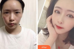 廣安阿藍(lán)醫(yī)院醫(yī)療美容科蘭洪明整形價(jià)格表附眼部綜合案例展示