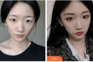 廣安華美悅美整形美容醫(yī)院蔣朝華整形價(jià)格表附切開雙眼皮案例展示