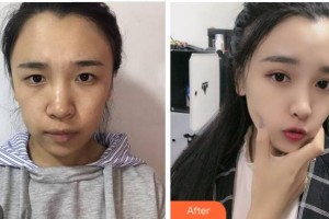 達(dá)州仁美醫(yī)學(xué)整形美容門診部周院長整形價(jià)格表附眼部綜合案例展示