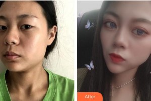 達(dá)州仁美醫(yī)學(xué)整形美容門診部周奇濤整形價(jià)格表附眼部綜合案例展示