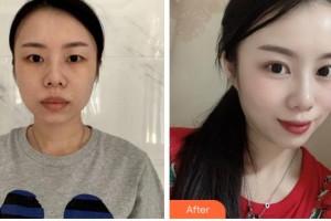 達(dá)州愛爾博視醫(yī)院吳松整形價(jià)格表附眼部綜合案例展示