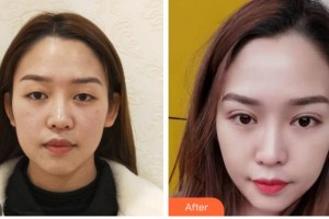 達(dá)州愛爾博視醫(yī)院鄒林整形價(jià)格表附眶隔脂肪釋放案例展示