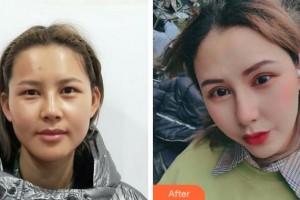 達(dá)州愛爾博視醫(yī)院胡建斌整形價(jià)格表附上瞼提肌案例展示