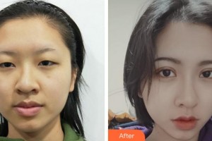 達(dá)州愛爾博視醫(yī)院蔣幼芹整形價(jià)格表附開內(nèi)眼角案例展示