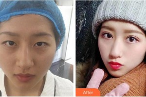 達(dá)州愛爾博視醫(yī)院周奇志整形價(jià)格表附眼部綜合案例展示