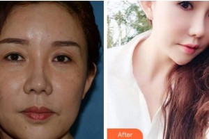 達(dá)州愛爾博視醫(yī)院許龍華整形價(jià)格表附外切祛眼袋案例展示