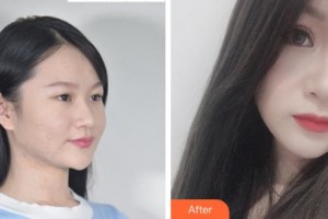 達(dá)州愛爾博視醫(yī)院王錚整形價(jià)格表附眼部綜合案例展示