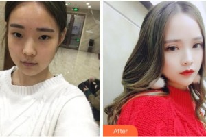 達(dá)州市中西醫(yī)結(jié)合醫(yī)院眼科甘國菊整形價(jià)格表附切開雙眼皮案例展示