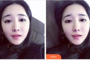 達(dá)州愛瑞眼科醫(yī)院匡毅整形價(jià)格表附上眼瞼去脂案例展示