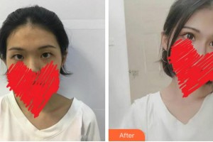 達(dá)州市中西醫(yī)結(jié)合醫(yī)院眼科劉進(jìn)整形價(jià)格表附切開雙眼皮案例展示