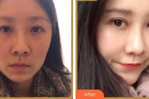 雅安市人民醫(yī)院燒傷整形科付子俊整形價(jià)格表附眼部綜合案例展示