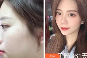 雅安鑫西華口腔整形醫(yī)院劉國敏整形價(jià)格表附金屬托槽矯正案例展示