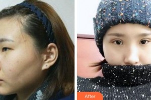 巴中麗人醫(yī)院醫(yī)療美容科孫衛(wèi)星整形價(jià)格表附切開雙眼皮案例展示