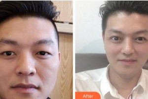 巴中時(shí)光醫(yī)學(xué)美容門診部李洪強(qiáng)整形價(jià)格表附切開雙眼皮案例展示