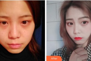 資陽麗人醫(yī)療美容門診部黃衛(wèi)紅整形價(jià)格表附激光祛斑案例展示