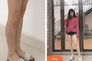 資陽市第一人民醫(yī)院燒傷整形科伍建華整形價(jià)格表附激光祛疤案例展示