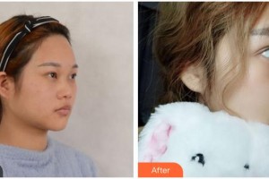 資陽麗人醫(yī)療美容門診部肖麗整形價(jià)格表附鼻部綜合案例展示