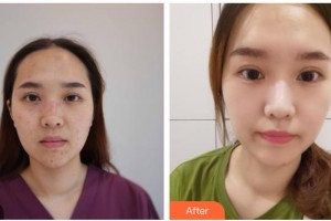 資陽麗人醫(yī)療美容門診部柯春整形價(jià)格表附激光點(diǎn)痣案例展示