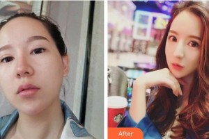 資陽伊之美整形美容醫(yī)院張梅整形價(jià)格表附鼻部綜合案例展示