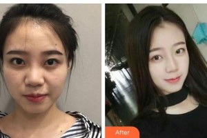 資陽伊之美整形美容醫(yī)院李正勇整形價(jià)格表附鼻部綜合案例展示