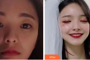 資陽伊之美整形美容醫(yī)院鄒家旋整形價(jià)格表附美白導(dǎo)入案例展示