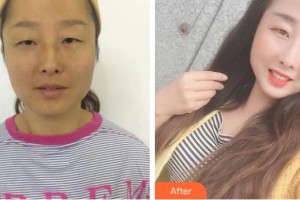 資陽市中醫(yī)醫(yī)院眼科楊建芳整形價(jià)格表附內(nèi)切祛眼袋案例展示