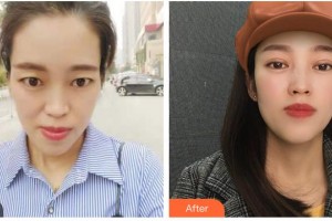 資陽維多利亞醫(yī)療美容醫(yī)院黃國強(qiáng)整形價(jià)格表附切開雙眼皮案例展示