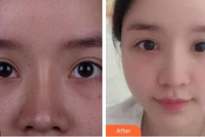 資陽市中醫(yī)醫(yī)院眼科王耀住院醫(yī)師整形價(jià)格表附眼部修復(fù)案例展示