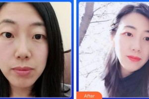 資陽市中醫(yī)醫(yī)院眼科黃緒清整形價(jià)格表附切開雙眼皮案例展示